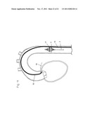 CATHETER PUMP FOR CIRCULATORY SUPPORT diagram and image