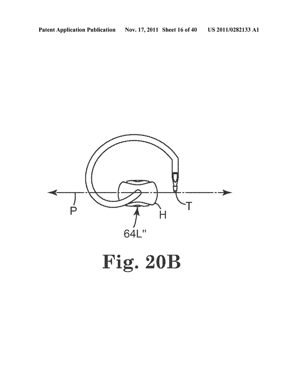 TRANSOBTURATOR SURGICAL ARTICLES AND METHODS - diagram, schematic, and image 17