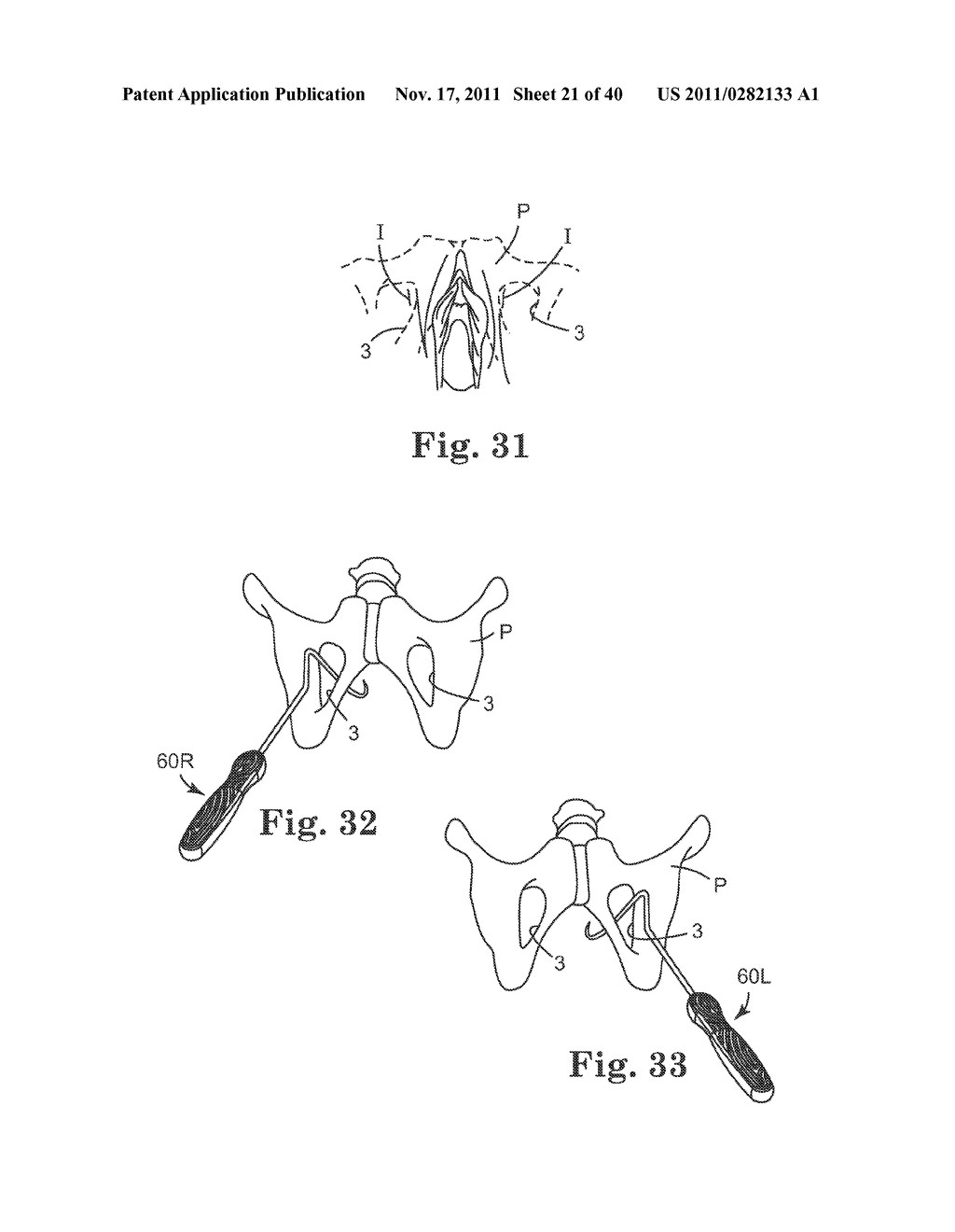 TRANSOBTURATOR SURGICAL ARTICLES AND METHODS - diagram, schematic, and image 22