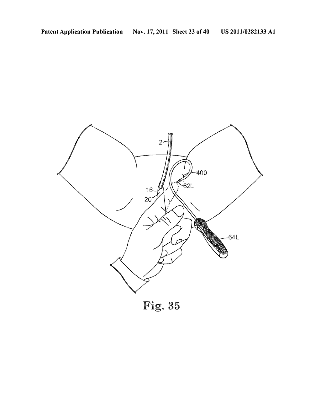 TRANSOBTURATOR SURGICAL ARTICLES AND METHODS - diagram, schematic, and image 24