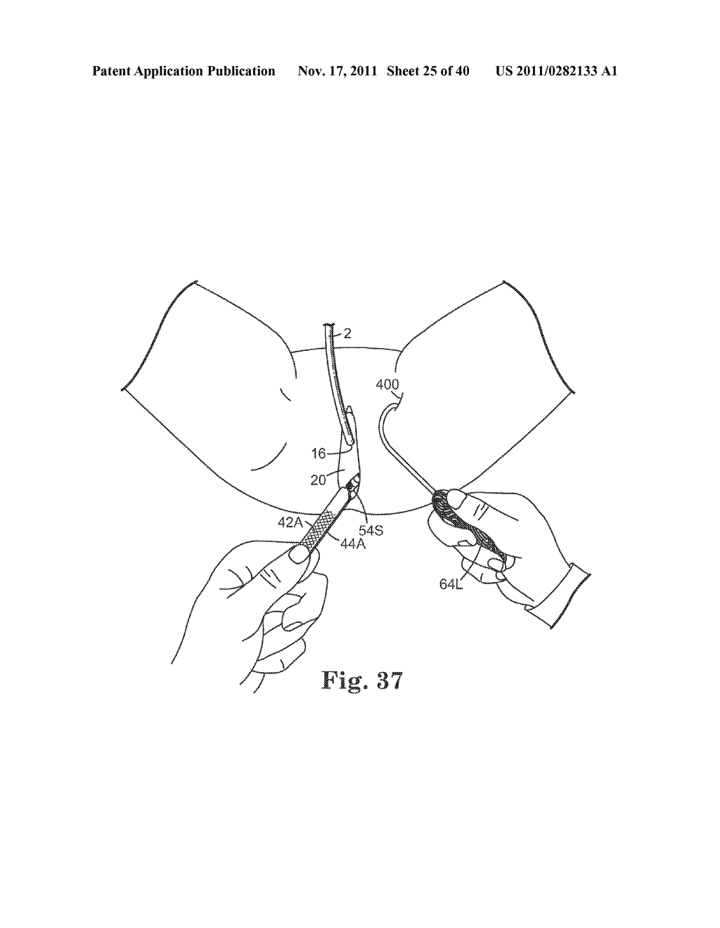 TRANSOBTURATOR SURGICAL ARTICLES AND METHODS - diagram, schematic, and image 26