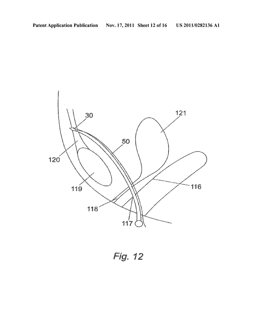 SYSTEM FOR INTRODUCING SOFT TISSUE ANCHORS - diagram, schematic, and image 13