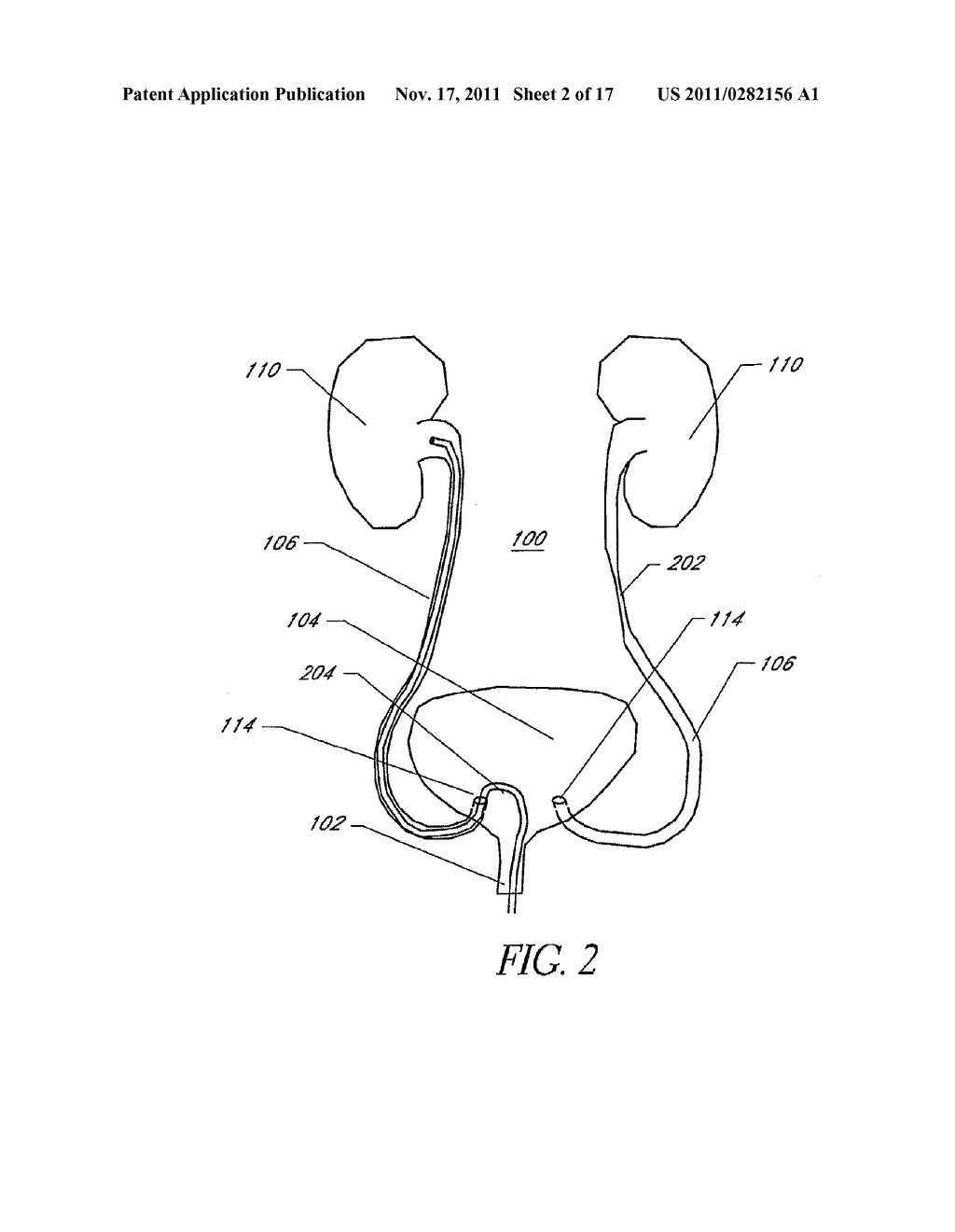 EXPANDABLE TRANSLUMINAL SHEATH - diagram, schematic, and image 03