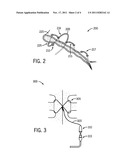 Sternal Closure Wire For Sensing And Therapeutic Energy Delivery diagram and image