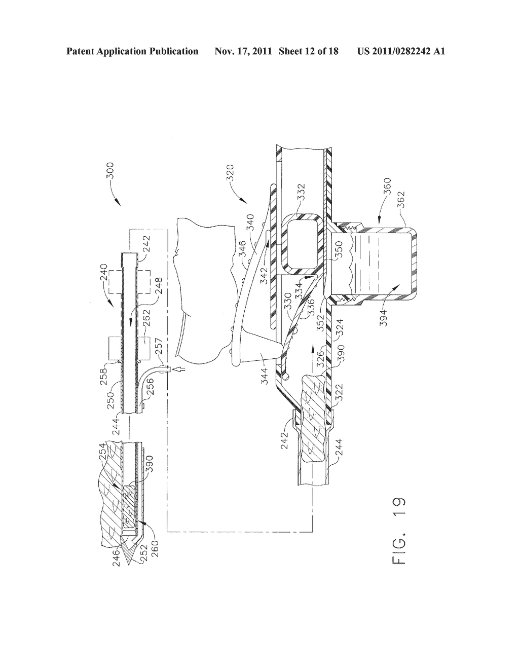 Instrument for Applying Therapeutic Cells, with Proximal Portion for     Processing Therapeutic Cells - diagram, schematic, and image 13