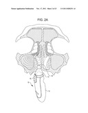 Methods and Systems for Delivery of Acoustic Energy to Tissue Surfaces,     Cavities and Obstructed Passages such as Intranasal Ostia diagram and image