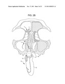 Methods and Systems for Delivery of Acoustic Energy to Tissue Surfaces,     Cavities and Obstructed Passages such as Intranasal Ostia diagram and image