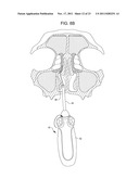 Methods and Systems for Delivery of Acoustic Energy to Tissue Surfaces,     Cavities and Obstructed Passages such as Intranasal Ostia diagram and image