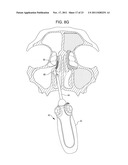 Methods and Systems for Delivery of Acoustic Energy to Tissue Surfaces,     Cavities and Obstructed Passages such as Intranasal Ostia diagram and image