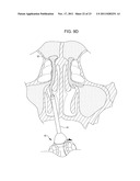 Methods and Systems for Delivery of Acoustic Energy to Tissue Surfaces,     Cavities and Obstructed Passages such as Intranasal Ostia diagram and image