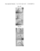 INCURVATED NAIL CORRECTION TOOL diagram and image