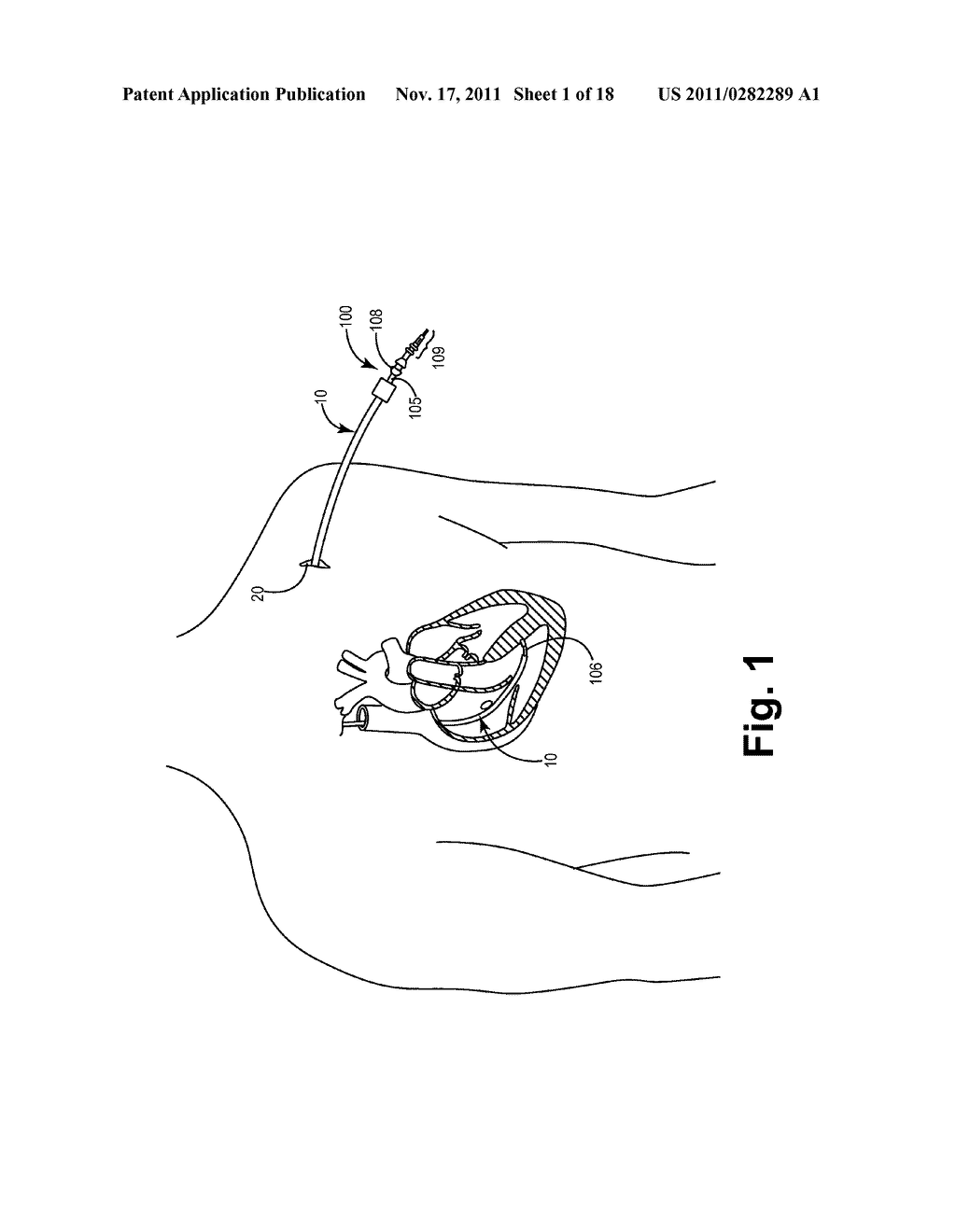 Systems and Methods for Gaining Access Around an Implanted Medical Device - diagram, schematic, and image 02