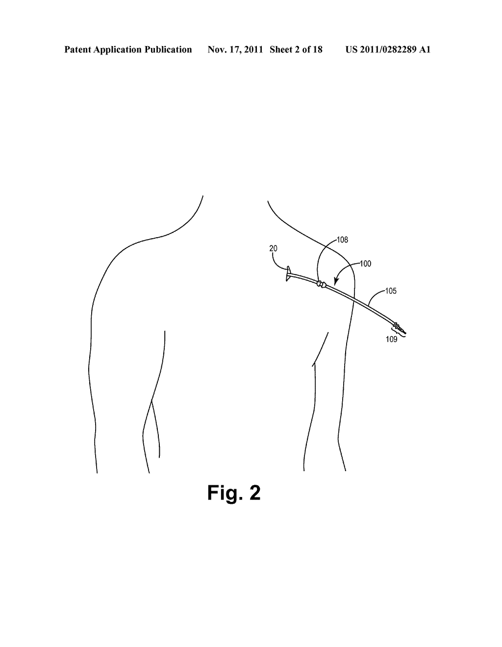 Systems and Methods for Gaining Access Around an Implanted Medical Device - diagram, schematic, and image 03