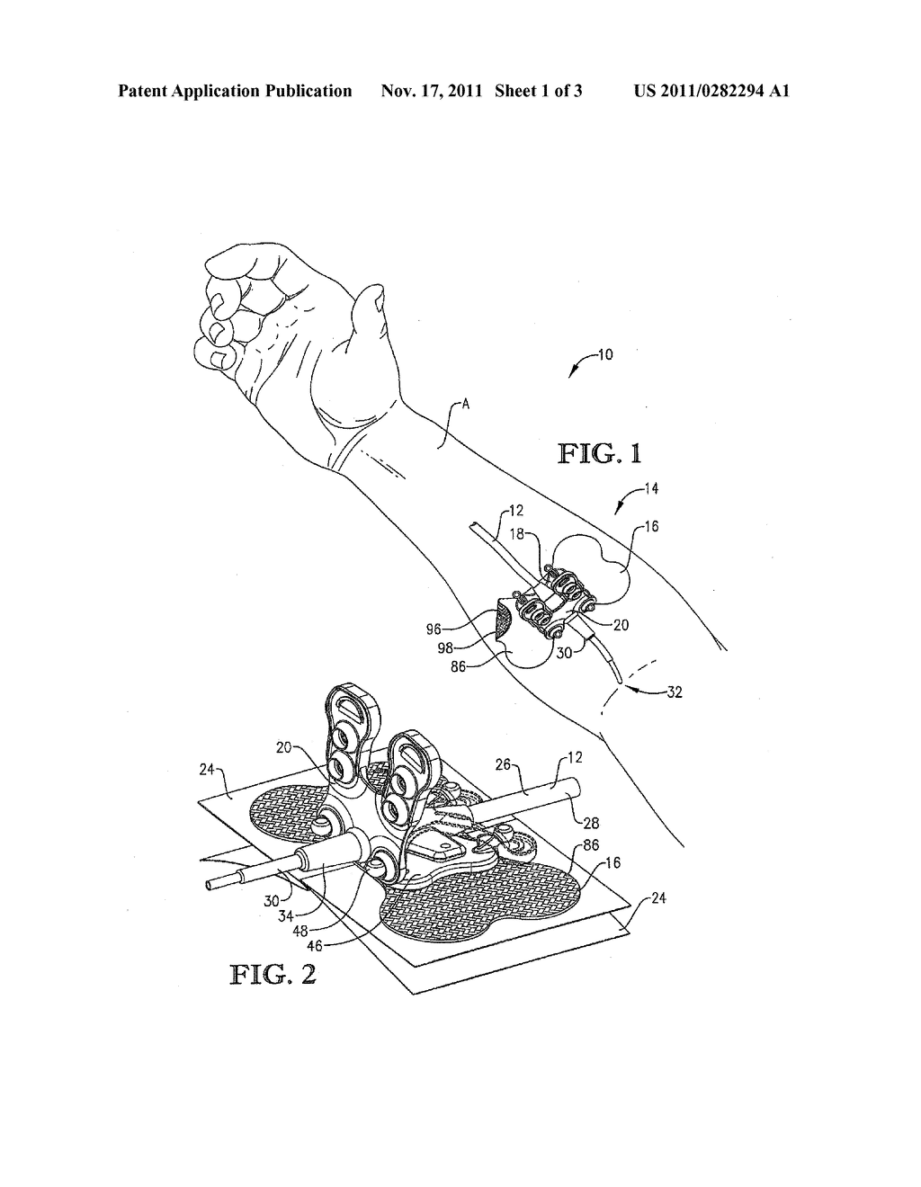 INTRAVENOUS SECUREMENT DEVICE WITH ADHESIVELY INTERCONNECTED ANCHORING     COMPONENT AND PERMEABLE ADHESIVE STRIP - diagram, schematic, and image 02