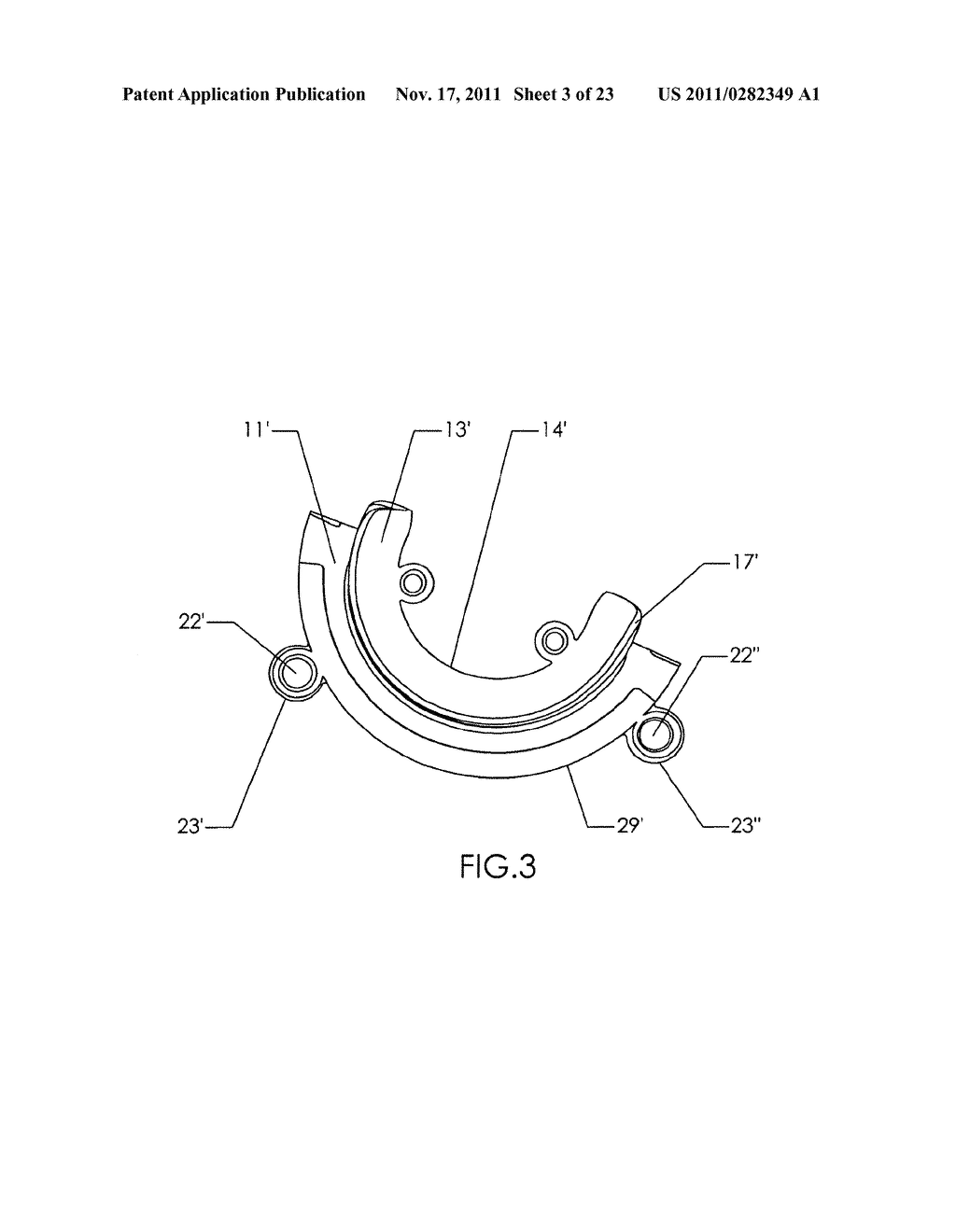 METHODS FOR IMPLANTING A JOINT PROSTHESIS - diagram, schematic, and image 04