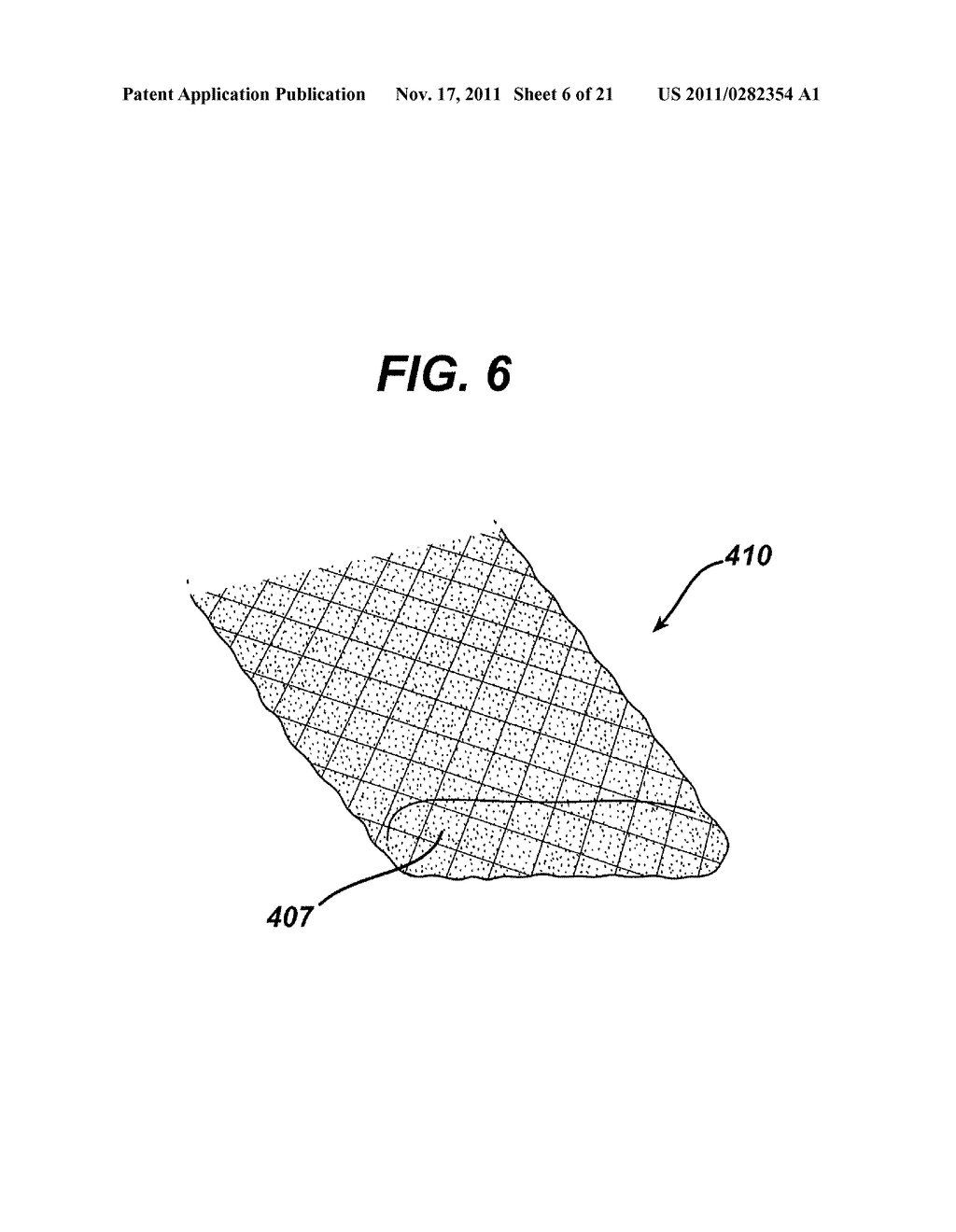 Fistula Cleaning and Repair Device and Method - diagram, schematic, and image 07