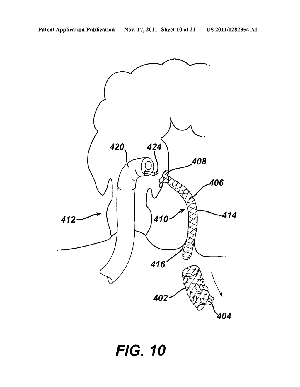 Fistula Cleaning and Repair Device and Method - diagram, schematic, and image 11