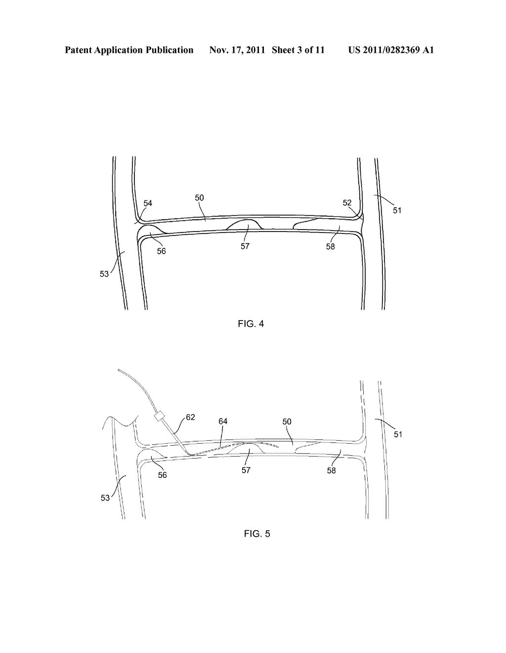 APPARATUS AND METHODS FOR ACCESSING AND REMOVING MATERIAL FROM BODY LUMENS - diagram, schematic, and image 04
