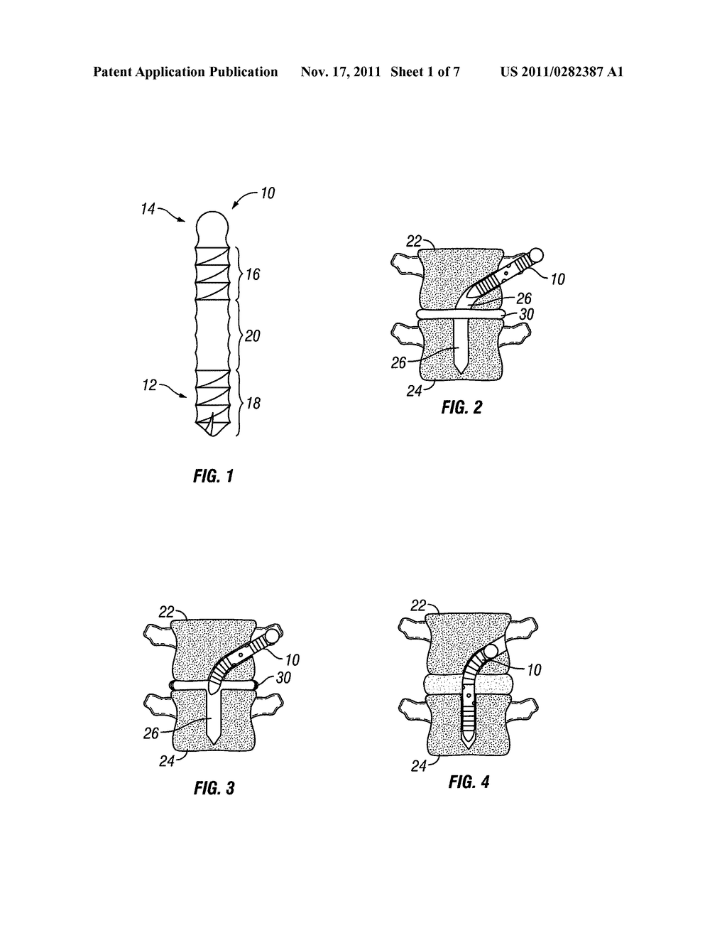 Distraction Screw - diagram, schematic, and image 02