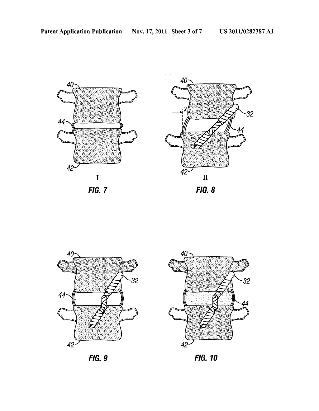 Distraction Screw - diagram, schematic, and image 04