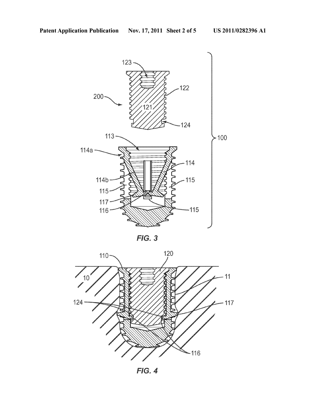 IMPLANT WITH DEPLOYABLE STABILIZERS - diagram, schematic, and image 03