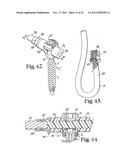 Polyaxial bone screw with cam connection and lock and release insert diagram and image