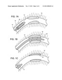 Endoprosthesis diagram and image