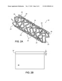 Endoprosthesis diagram and image