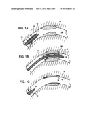 ENDOPROSTHESIS diagram and image