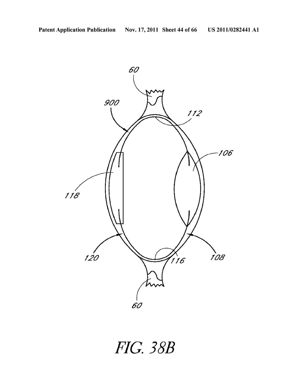 INTRAOCULAR LENS WITH POST-IMPLANTATION ADJUSTMENT CAPABILITIES - diagram, schematic, and image 45