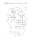 Transport device for ossicular prosthesis diagram and image