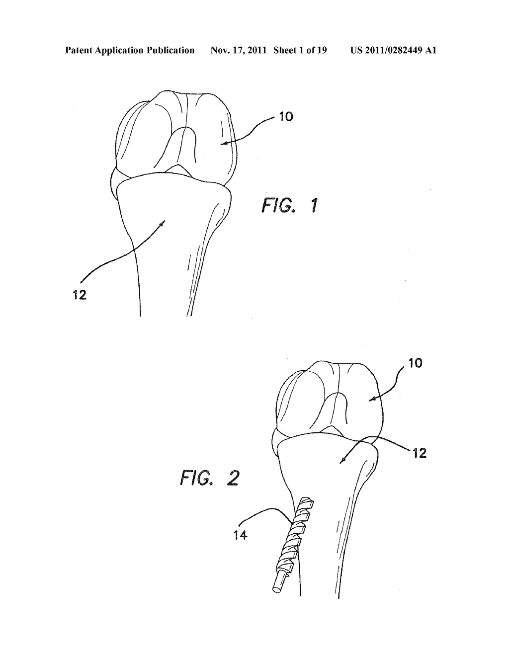 DEVICES, SYSTEMS, AND METHODS FOR MATERIAL FIXATION - diagram, schematic, and image 02