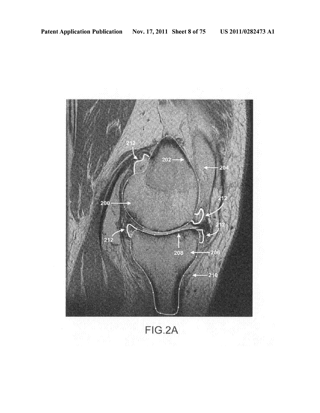 System and method for image segmentation in generating computer models of     a joint to undergo arthroplasty - diagram, schematic, and image 09