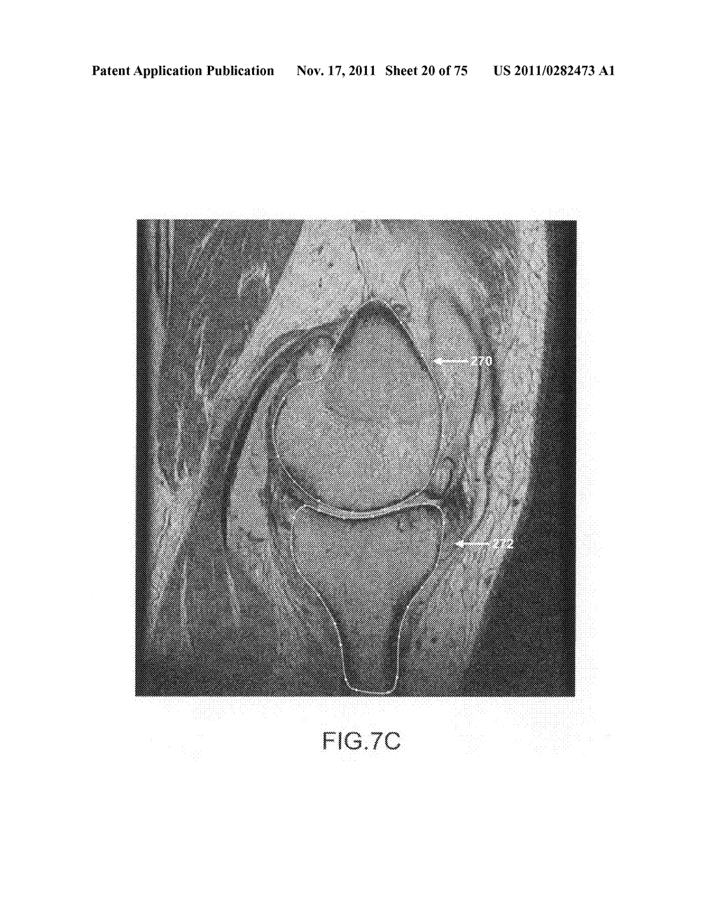 System and method for image segmentation in generating computer models of     a joint to undergo arthroplasty - diagram, schematic, and image 21