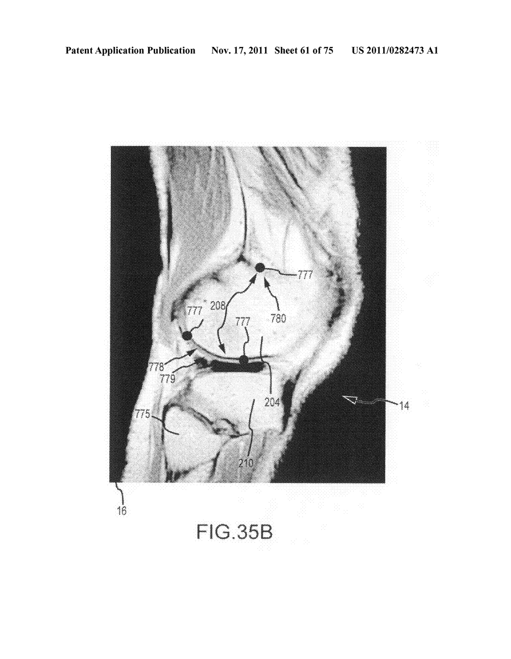 System and method for image segmentation in generating computer models of     a joint to undergo arthroplasty - diagram, schematic, and image 62