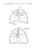 REMOVABLE ANCHORED LUNG VOLUME REDUCTION DEVICES AND METHODS diagram and image