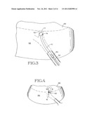 REMOVABLE ANCHORED LUNG VOLUME REDUCTION DEVICES AND METHODS diagram and image