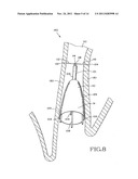 REMOVABLE ANCHORED LUNG VOLUME REDUCTION DEVICES AND METHODS diagram and image