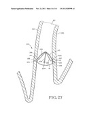 REMOVABLE ANCHORED LUNG VOLUME REDUCTION DEVICES AND METHODS diagram and image