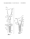 DENTAL IMPLANT diagram and image