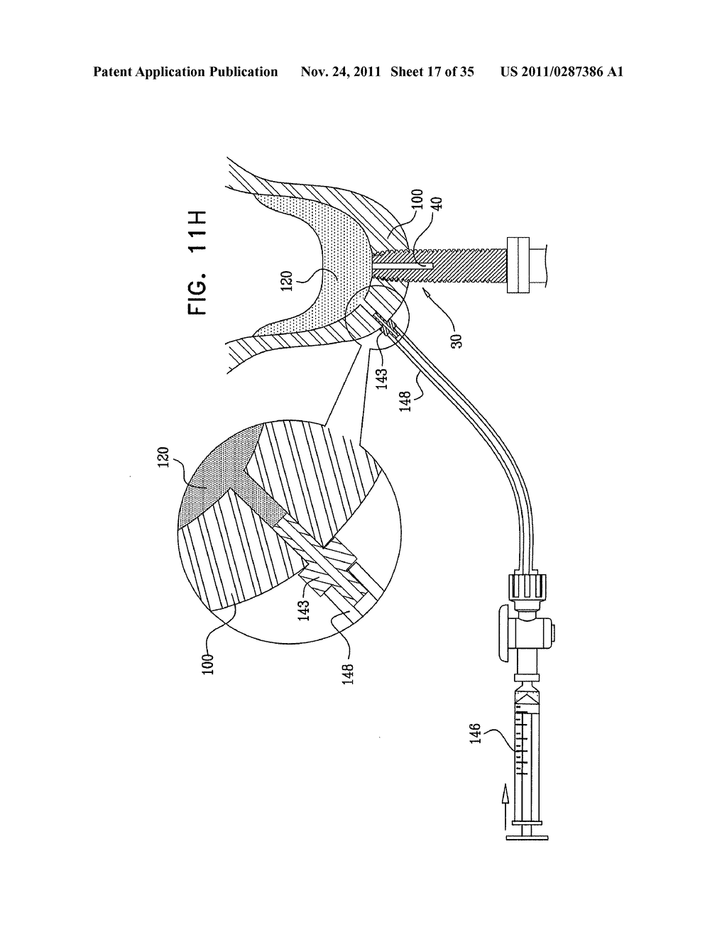 IMPLANTS, TOOLS, AND METHODS FOR SINUS LIFT AND LATERAL RIDGE AUGMENTATION - diagram, schematic, and image 18