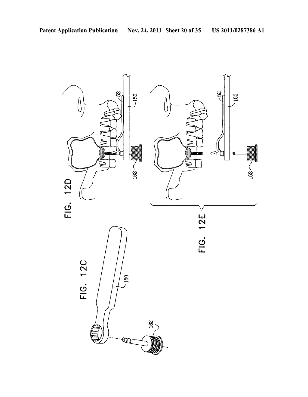 IMPLANTS, TOOLS, AND METHODS FOR SINUS LIFT AND LATERAL RIDGE AUGMENTATION - diagram, schematic, and image 21