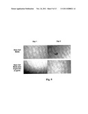 ADMINISTRATION OF ANGIOCIDIN FOR THE TREATMENT OF CANCER diagram and image