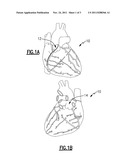 Surgical Approach to Treat Coronary Artery Syndromes diagram and image