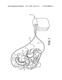 DIASTOLIC CORONARY PERFUSION DETECTION FOR TIMED DELIVERY OF THERAPEUTIC     AND/OR DIAGNOSTIC AGENTS diagram and image