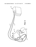 DIASTOLIC CORONARY PERFUSION DETECTION FOR TIMED DELIVERY OF THERAPEUTIC     AND/OR DIAGNOSTIC AGENTS diagram and image