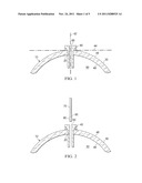 OCULAR SURGICAL PROCEDURE diagram and image