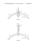 OCULAR SURGICAL PROCEDURE diagram and image