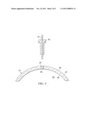 OCULAR SURGICAL PROCEDURE diagram and image