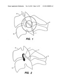 Apparatus for Sizing a Facet Joint diagram and image